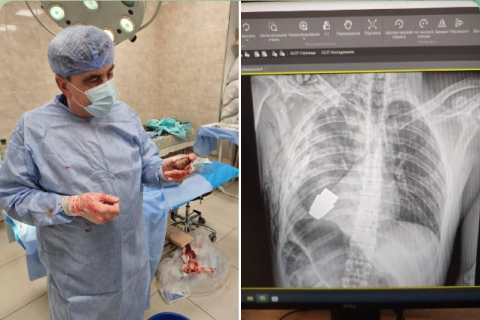 Український хірург витягнув бойову гранату з грудей солдата